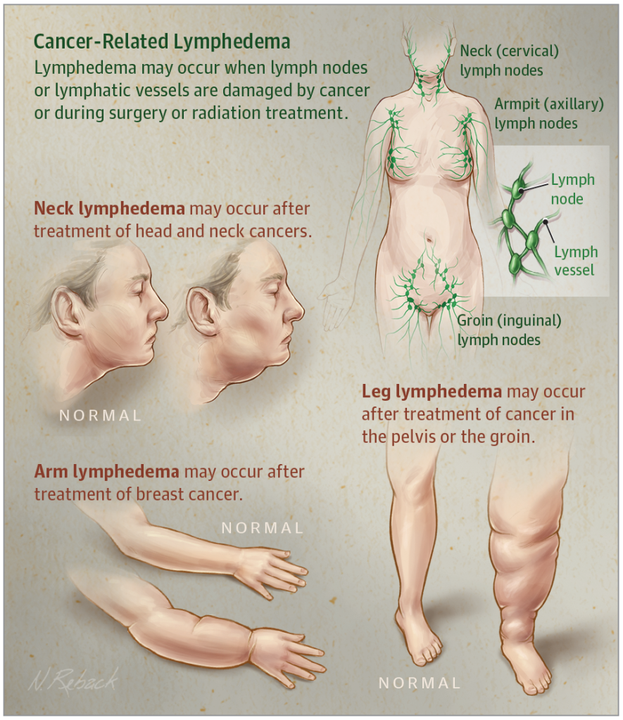 Image showing lymphedema problems