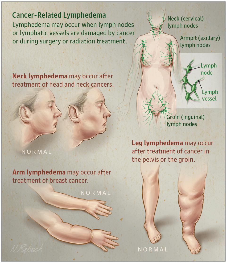 Breast Cancer and Lymphedema: What It Is, Why It Happens, and How It's  Treated