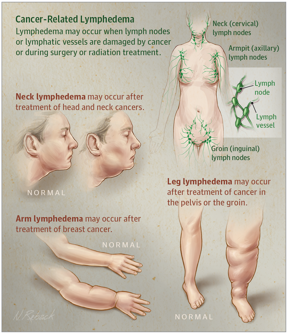 Helping Cancer Patients Handle Lymphedema After Surgery AU Health News