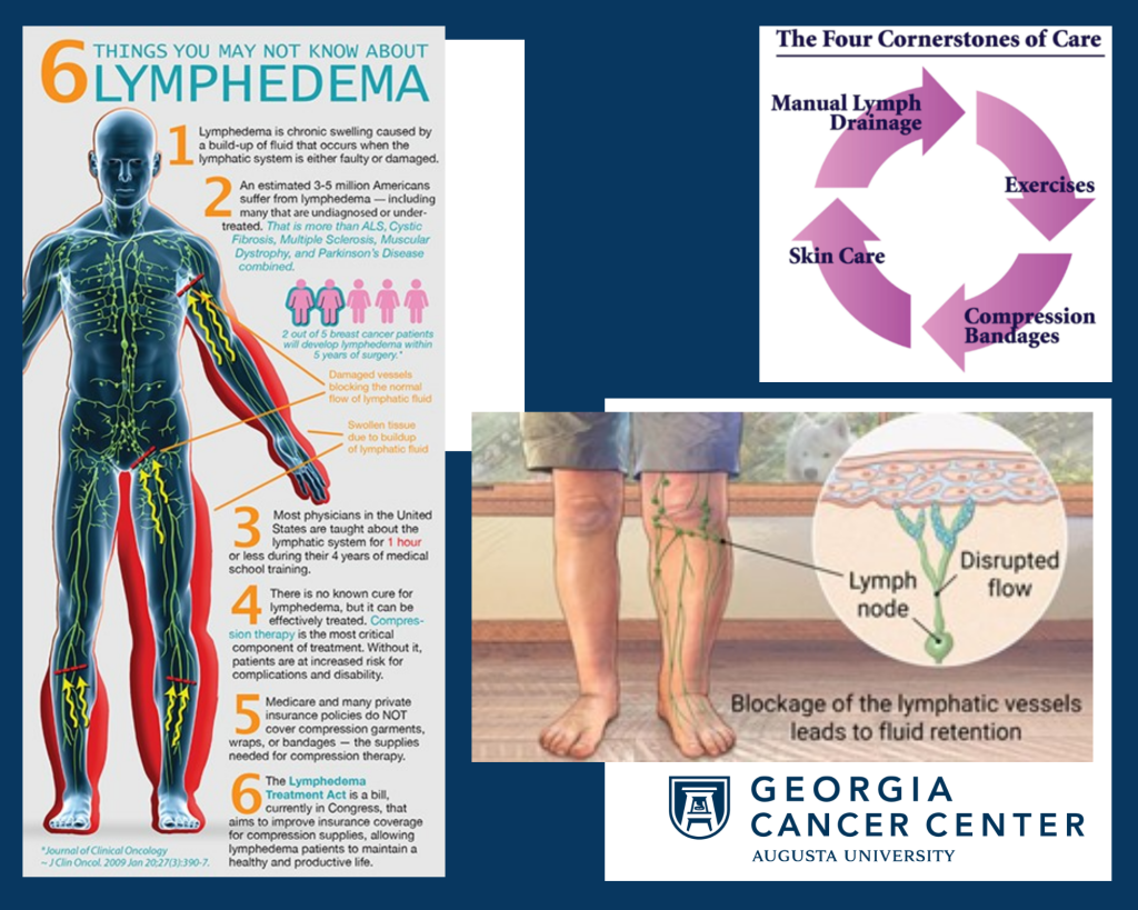 Images showing lymphedema treatment