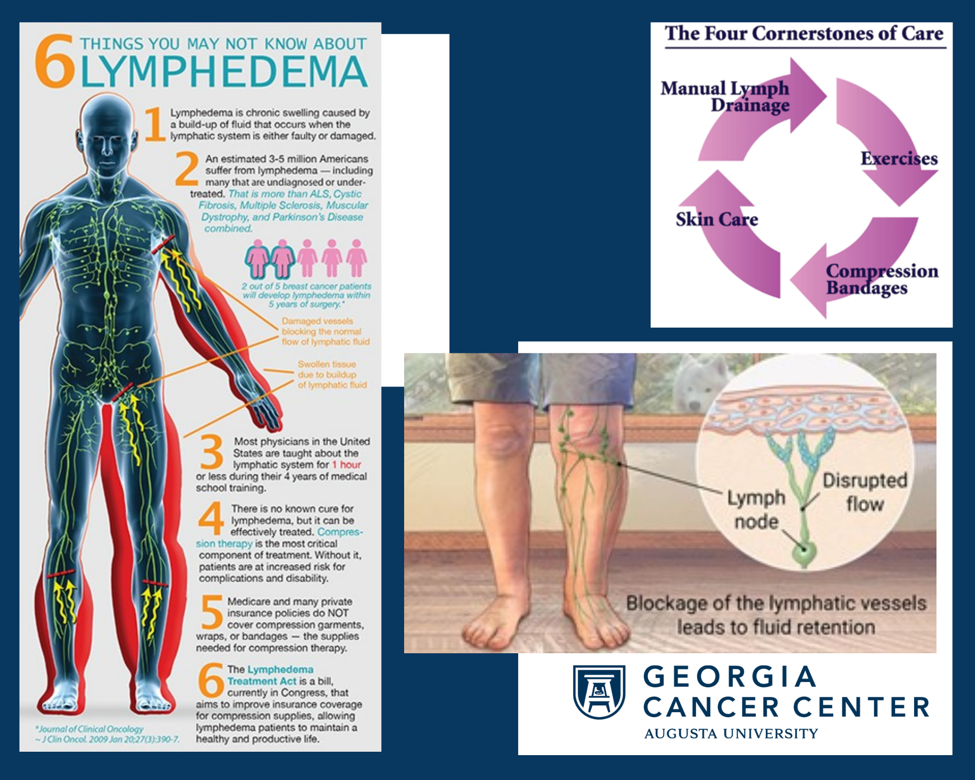 Lymphedema After Breast Cancer