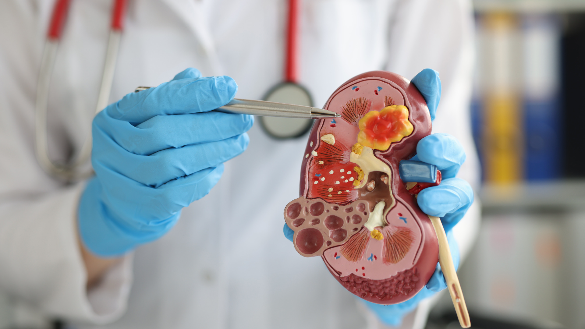 Blue gloves pointing at cancer on kidney model