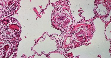 Piink microscopic image of sarcoidosis