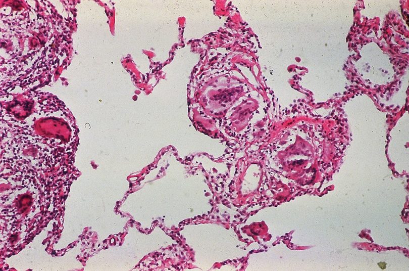 Piink microscopic image of sarcoidosis
